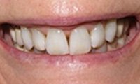 Oversized front teeth before cosmetic dentistry