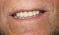 Perfectly restored smile with healthy teeth and gums