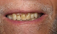 Smile with severe decay around the gums