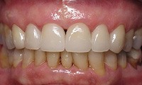 Healthy restored top row of teeth after cosmetic dentistry