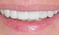 Gorgeous healthy smile after cosmetic dentistry