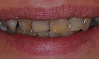 Damaged decayed teeth before cosmetic dentistry
