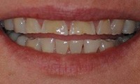 Worn yellow teeth before cosmetic dentistry
