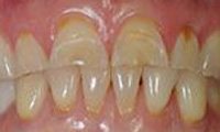 Yellow teeth before teeth whitening