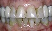 Severely discolred teeth and receded gum tissue