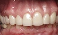Healthy beautiful smile after restorative dentistry