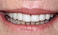 Perfected healthy smile after restorative dentistry
