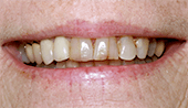 Severely discolored and decayed smile before restorative dentistry