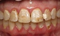 Severe tooth decay and discoloration before dental treatment