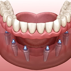 Digital illustration for dental implant dentures in Murphy