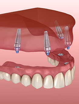Digital illustration of an implant denture in Murphy