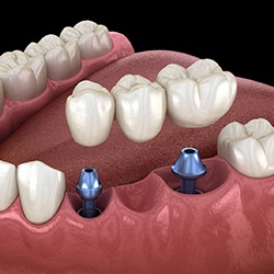 two dental implants securing a dental bridge into place 