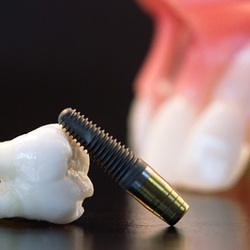 Dental implant and tooth in foreground, dental model in background