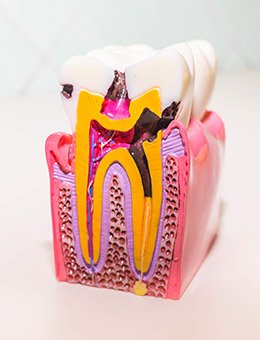 Model of tooth in need of root canal therapy