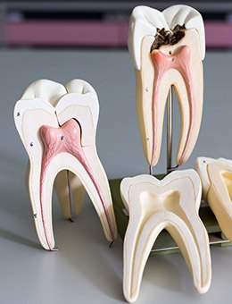 Three models of teeth during root canal therapy process