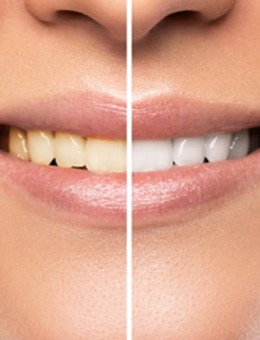 Before and after of patient's smile