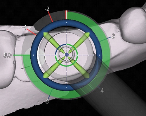 X-Guide being used to pinpoint precise location for dental implant