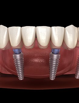 Dentures for lower arch supported by All-on-4 implants