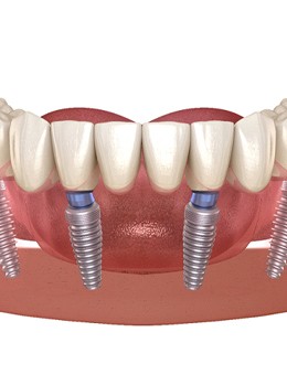 All-on-4 denture for lower arch against white background