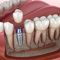 dental implant being placed in the lower jaw 
