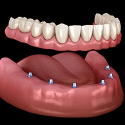 six dental implants supporting a full denture 