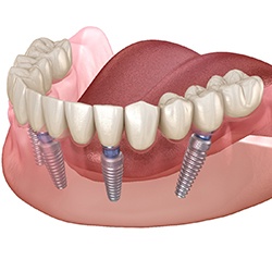 All-on-4 implant denture on the lower arch 