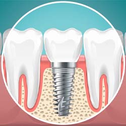 dental implant post integrating with the lower jawbone