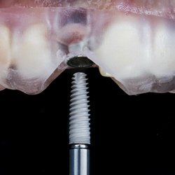 Surgical guide being used for dental implant placement