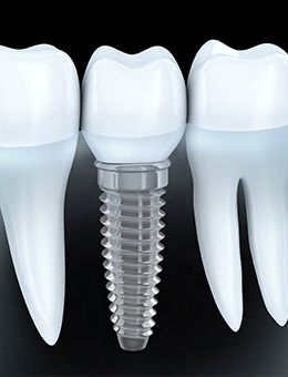 Animated dental implant supported tooth between natural teeth