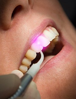 Soft tissue dental laser