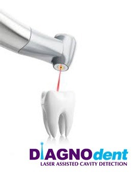 Diagnodent laser assisted cavity protection machine logo and animated process