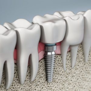 dental implant 3D illustration 