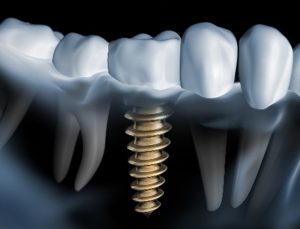 Digital model of a dental implant