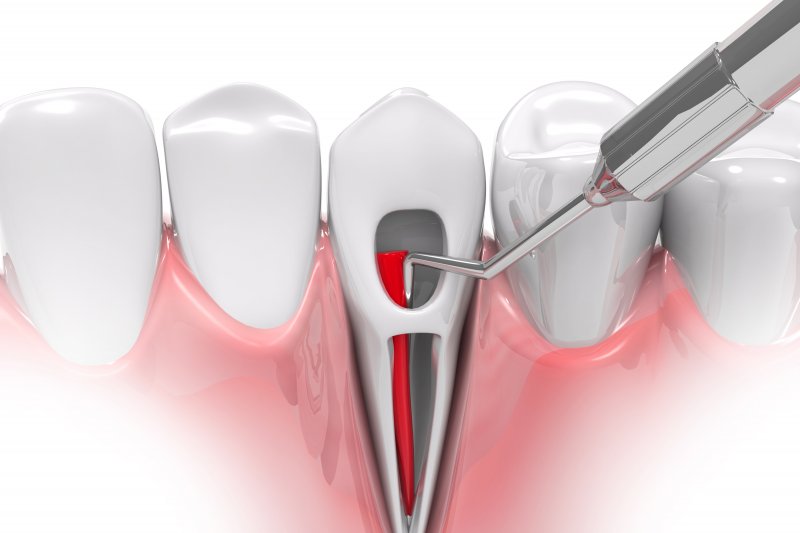 diagram explaining a root canal