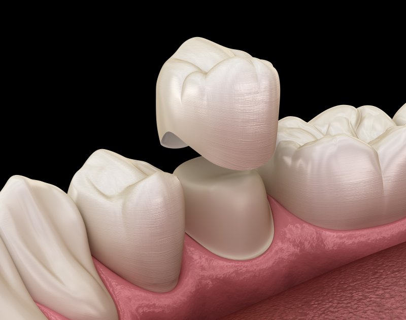 a digital image of a dental crown